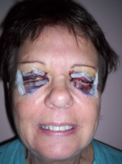 Procedures Dr Raf Ghabrial Cosmetic Eyelid Surgery Lower